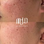 Acne Scar Treatment Options in the Philippines: What Medical Experts Say Works Best